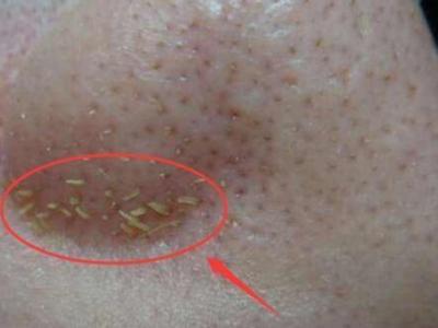 鼻子上擠出來的白色東西是什么？如何正確去除