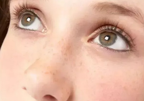 為什么皮膚白的容易長(zhǎng)斑？長(zhǎng)斑該如何護(hù)理？