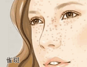 為什么皮膚白的容易長(zhǎng)斑？長(zhǎng)斑該如何護(hù)理？