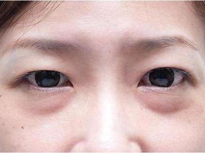 眼袋的形成原因,女性去眼袋最有效的土方法