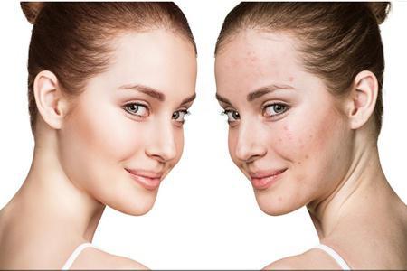 女生30歲臉上長痘痘的原因，長痘痘效果最佳的治療方法