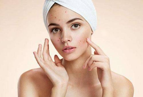 面部頻繁起痘是怎么回事？這4個原因要注意