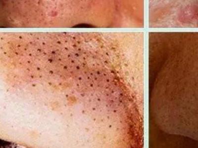 去黑頭粉刺妙招屢試有好效果 什么樣的膚質(zhì)容易有黑頭