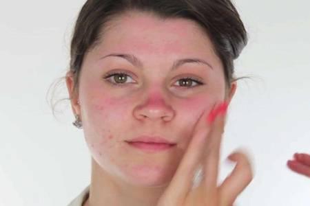 臉上長痘痘如何消除，六個(gè)小妙招祛痘簡單快捷