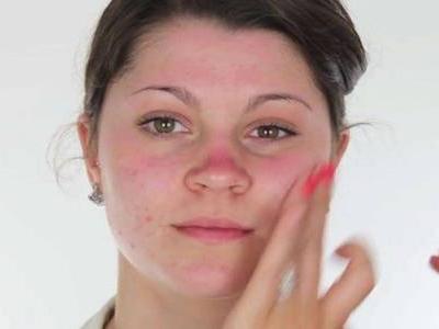 臉上長(zhǎng)痘痘如何消除，六個(gè)小妙招祛痘簡(jiǎn)單快捷