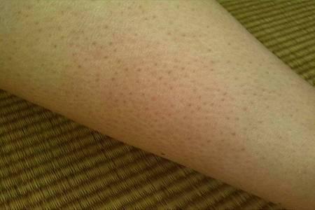 雞皮膚的四大形成原因，如何消除雞皮膚光滑肌膚