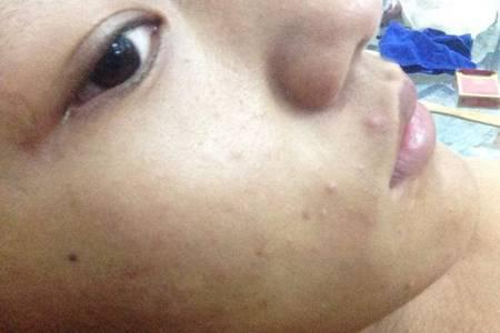 皮膚過敏癥狀有哪些，女性皮膚初期過敏如何治療