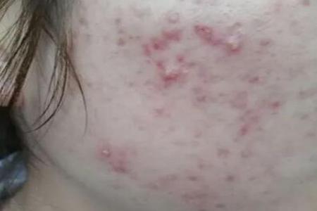 青春痘怎么快速消除？做好這5點或許好得快改善皮膚