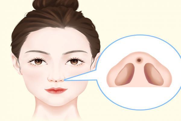 什么是骨粉隆鼻