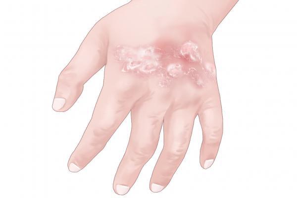 手上脫皮怎么治療