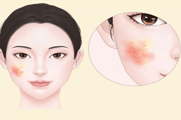 臉上很干燥起皮怎么辦