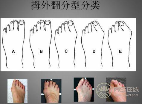 春季我們應該如何預防大腳骨