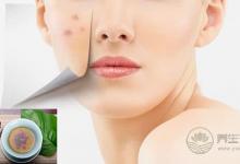 秋燥上火“痘痘”長,去痘要分虛實治