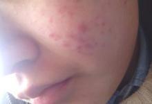 長青春痘怎么辦？不同位置有不同藥方