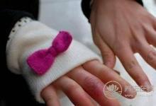 冬季該怎樣預(yù)防凍瘡?