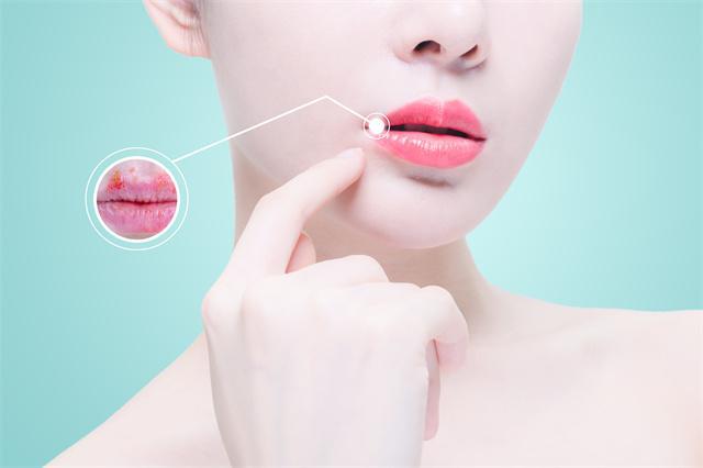 春天嘴唇經常干裂怎么辦？這些妙招幫你緩解