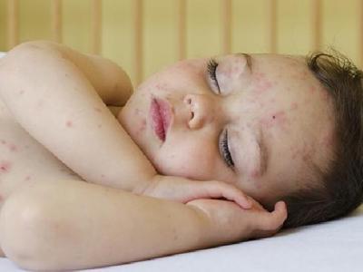 怎么調理花粉過敏體質 喝蜂蜜防過敏7個方法在家治過敏