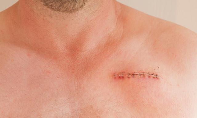 疤痕體質患者在日常生活中該如何預防疤痕？