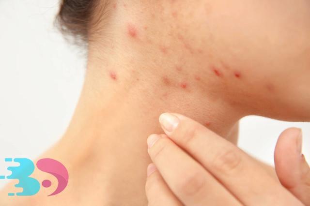 水土不服過敏多久能好，原來它還和身體素質有關!