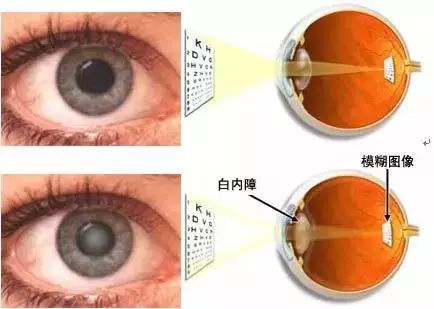 都是視力下降！白內(nèi)障、老花眼有何不同？