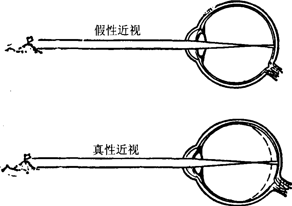 近視不戴眼鏡瞇眼睛都有哪些危害? 近視不戴眼鏡瞇眼睛都有哪些危害?