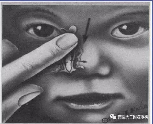 先天性淚道阻塞如何進行按摩？