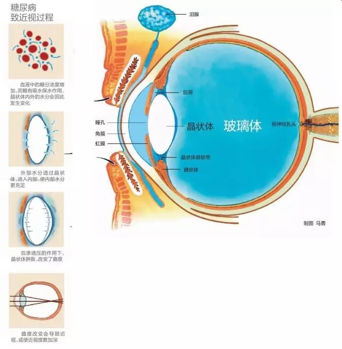 糖尿病會導致眼睛失明，視力模糊是前期征兆！