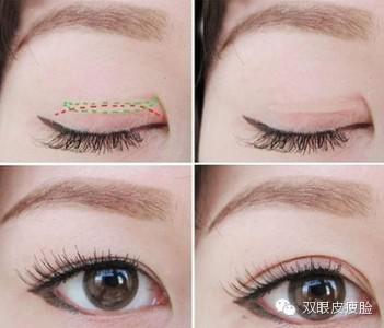 雙眼皮術前術后的注意事項