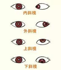 詳解近視、散光、遠視、斜視及弱視