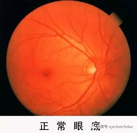 糖尿病眼底病變的病人，請注意！