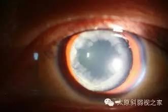 逃不開的眼疾病——白內障