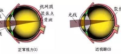 詳解近視、散光、遠(yuǎn)視、斜視及弱視