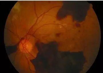 什么是散光？散光該如何保護眼睛？