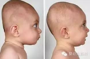 孩子的頭型與睡枕頭有關(guān)系嗎？