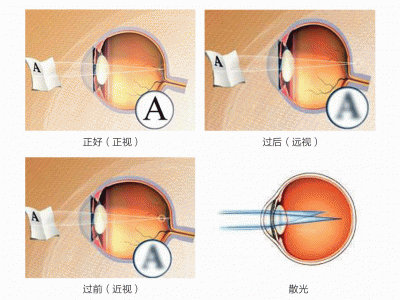 屈光不正是什么意思？
