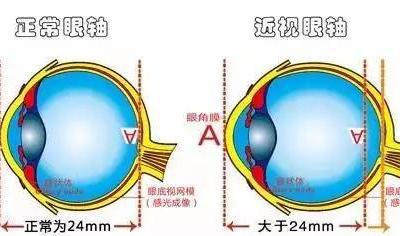 弱視是怎么形成的？它與近視有哪些區別？