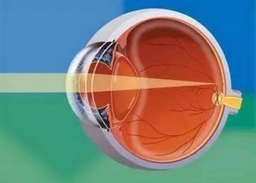 你的眼睛為什么會散光？