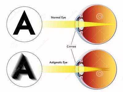 和你談?wù)勱P(guān)于結(jié)膜炎的那些事