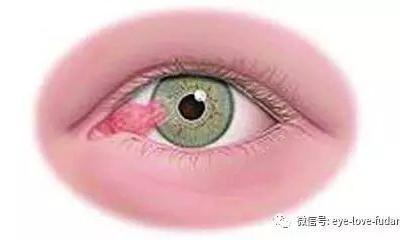 人眼為什么會長“多肉”？