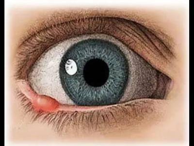 孩子長針眼怎么辦？