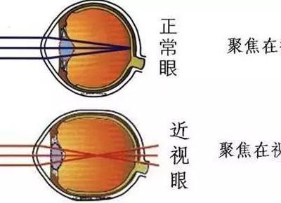 瞇眼睛真的能看的更清楚嗎？