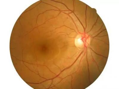 白內障術后仍然模糊怎么回事？