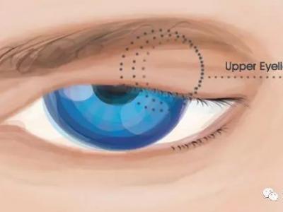 上瞼下垂知多少？