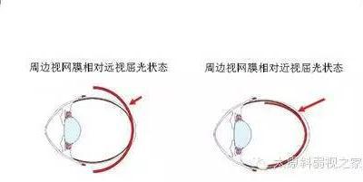 兒童近視防控中更應(yīng)重視離焦問(wèn)題