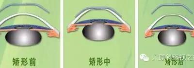 孩子度數持續增長怎么辦？