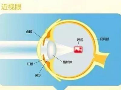 近視的原因、預(yù)防與治療