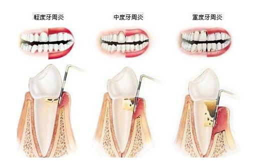 為什么會有牙周病？牙周病的中醫(yī)治療和保養(yǎng)方法