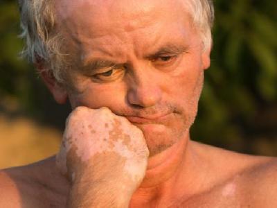 中醫(yī)針灸會(huì)不會(huì)疼? 這4種人不適合做針灸