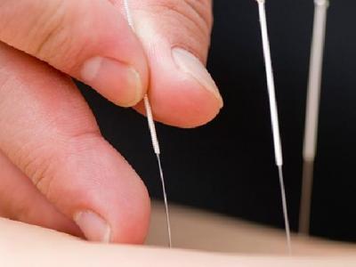 中醫治鼻咽癌的針灸療法有哪些 中醫針灸治鼻咽癌的四個療法