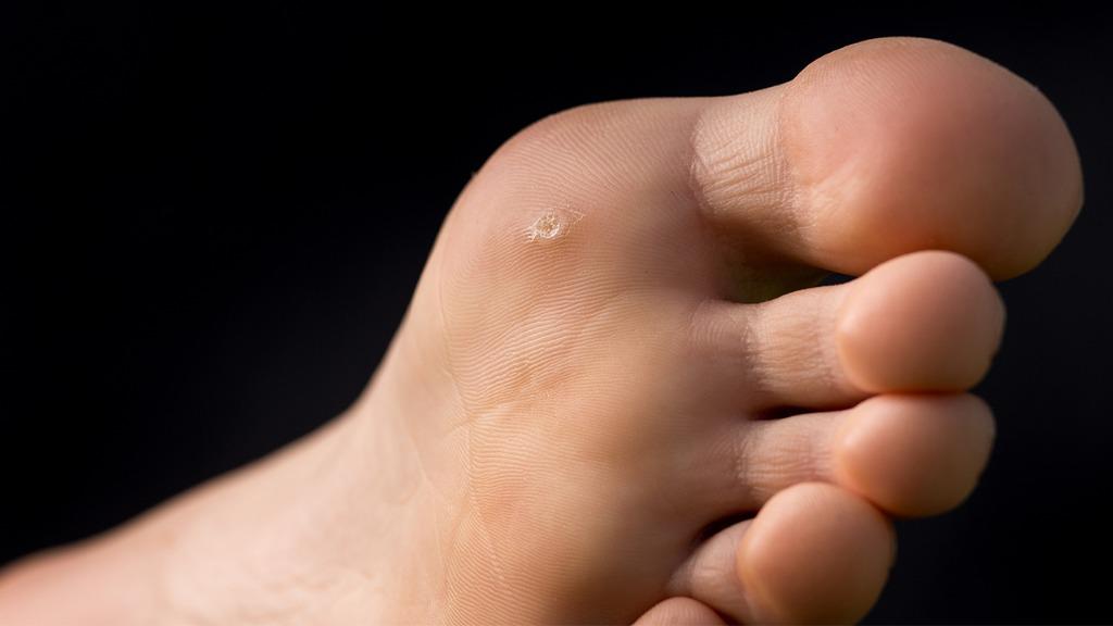 雞眼長見的部位有哪些 中醫針灸治療雞眼的方法